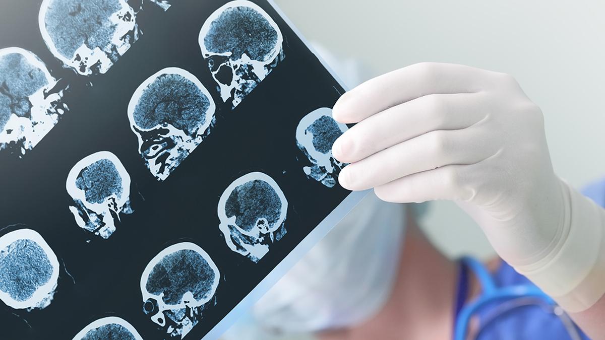 Advancements in Brain Tumor Treatment Provide New Hope for Patients